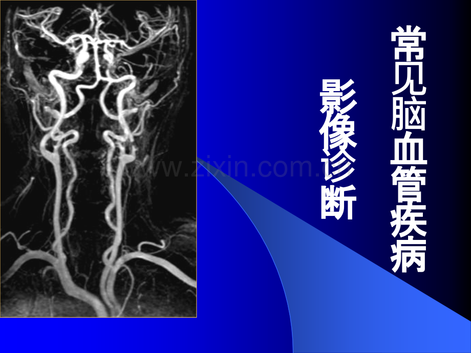 常见脑血管疾病的影像诊断.ppt_第1页