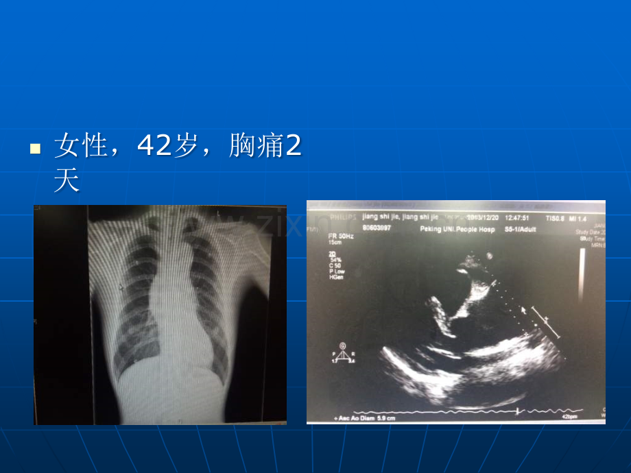 主动脉疾病的遗传倾向及基因变异.ppt_第2页