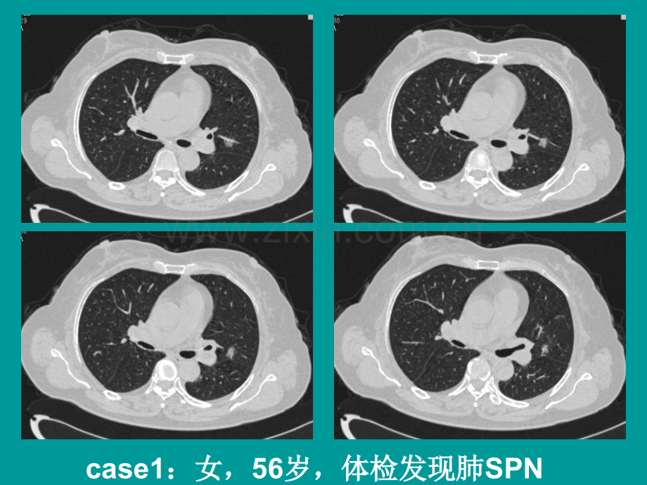 肺结节的检出与处理对策ppt课件.ppt_第2页