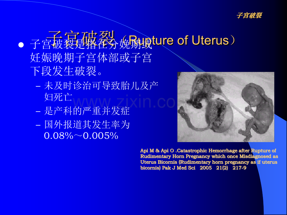 子宫破裂-Microsof-oweroin-演示文稿-.ppt_第3页