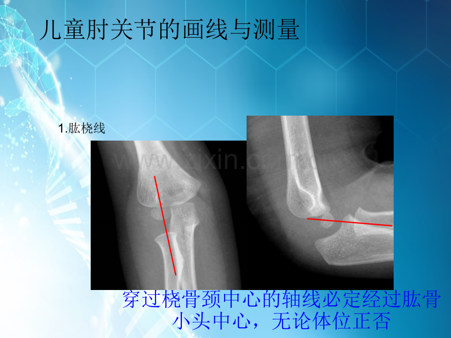 儿童肘关节损伤X线诊断ppt课件.ppt_第2页