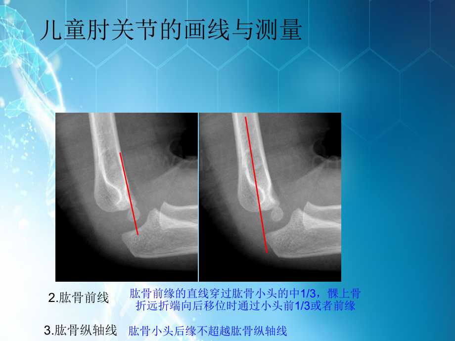 儿童肘关节损伤X线诊断ppt课件.ppt_第3页