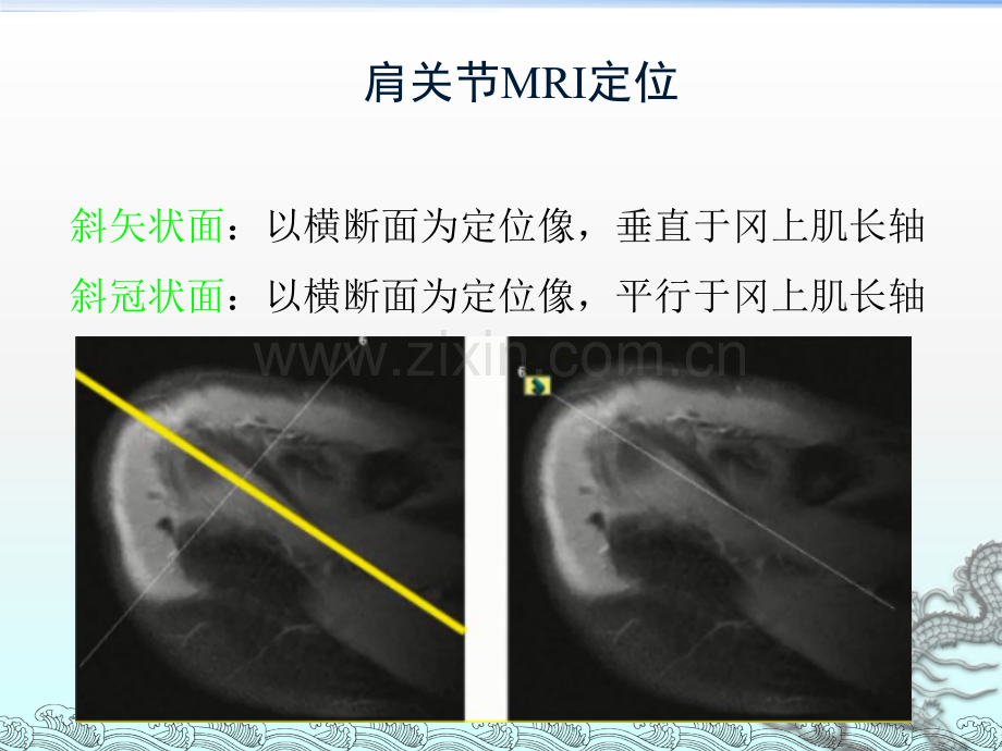 肩关节损伤的MRI诊断ppt课件.pptx_第3页