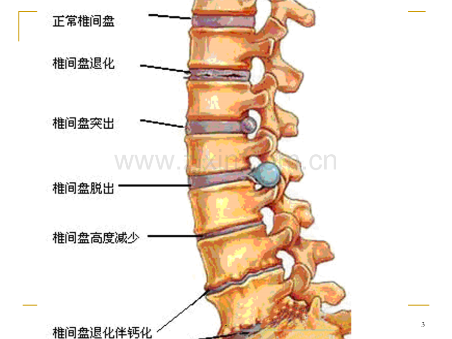 动态牵引治腰椎病PPT课件.ppt_第3页