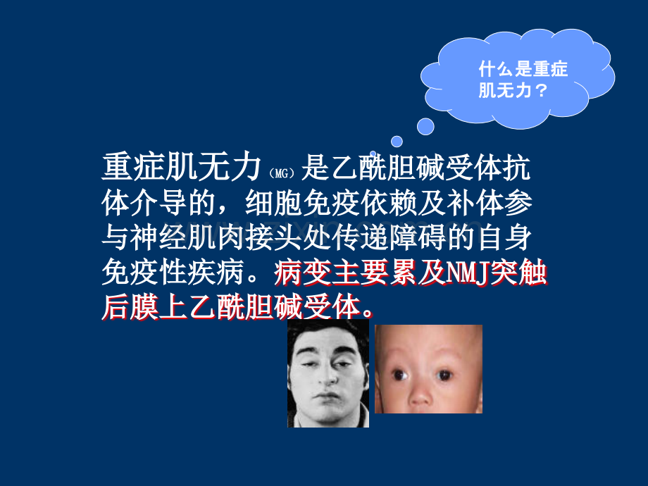 重症肌无力ppt课件.ppt_第2页