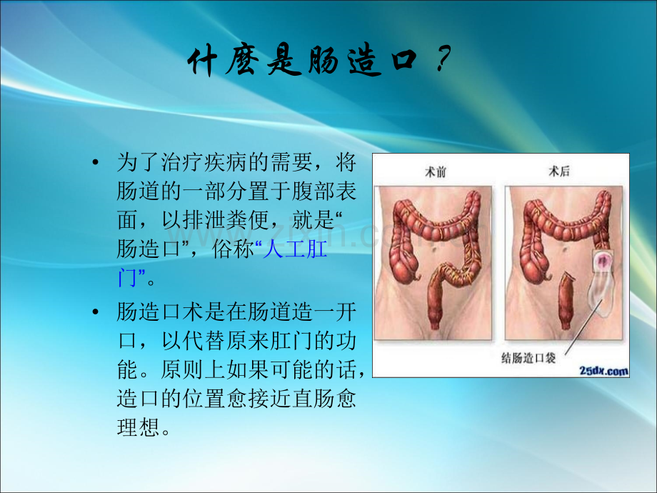 造口的分类.ppt_第3页