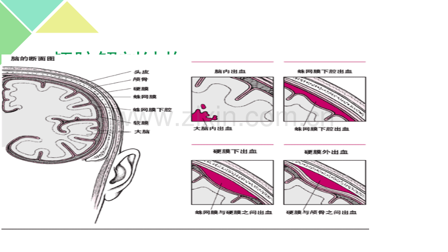 蛛网膜下腔出血的护理措施.ppt_第2页