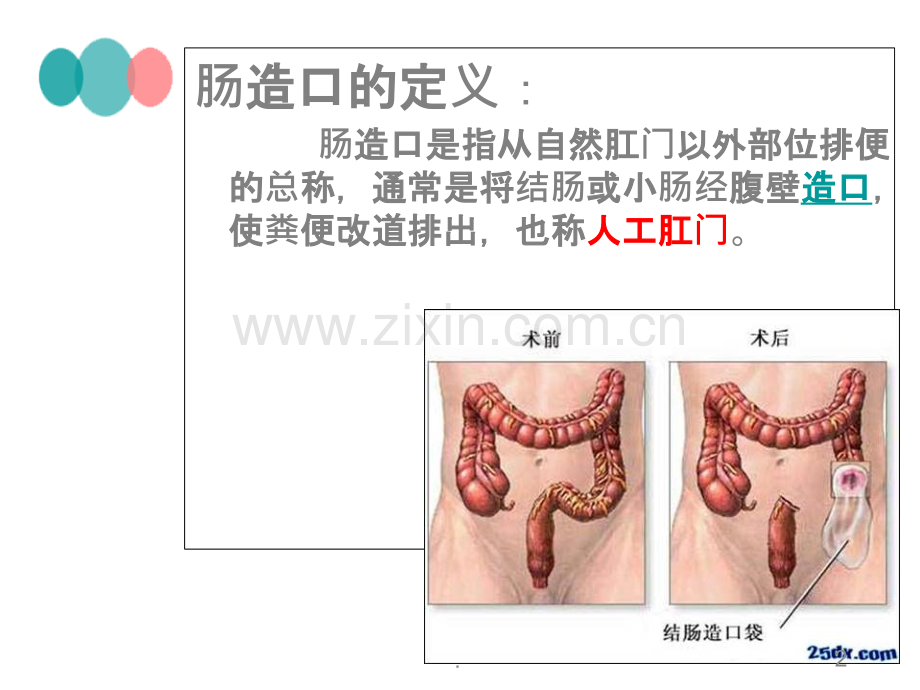 造瘘口的护理PPT课件.ppt_第2页