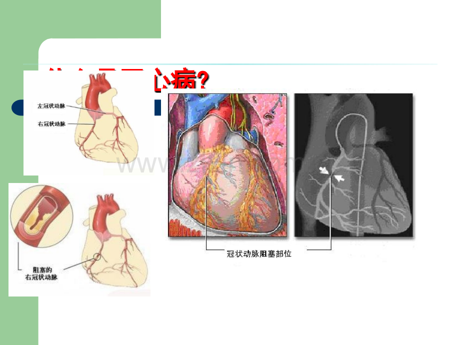 冬季冠心病防治患者教育.ppt_第2页