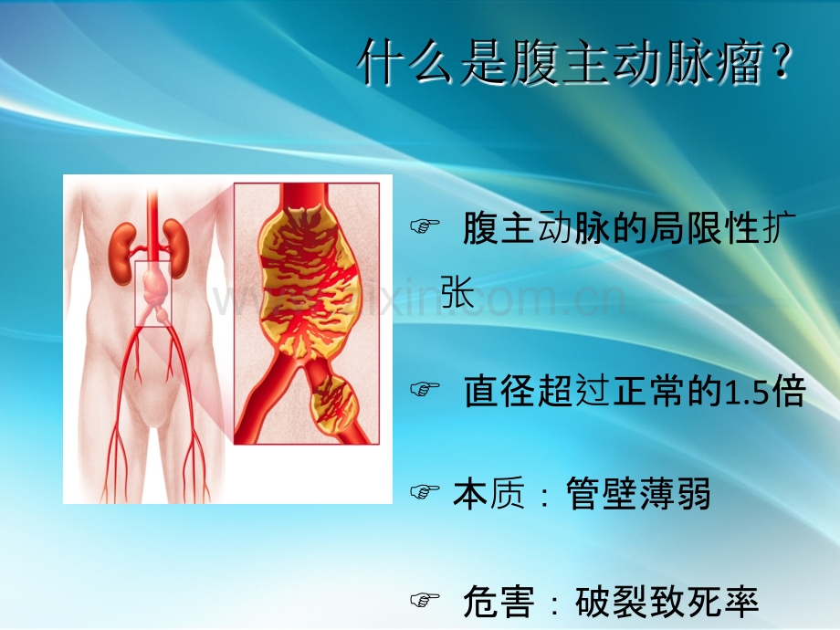 腹主动脉瘤(田静).ppt_第3页