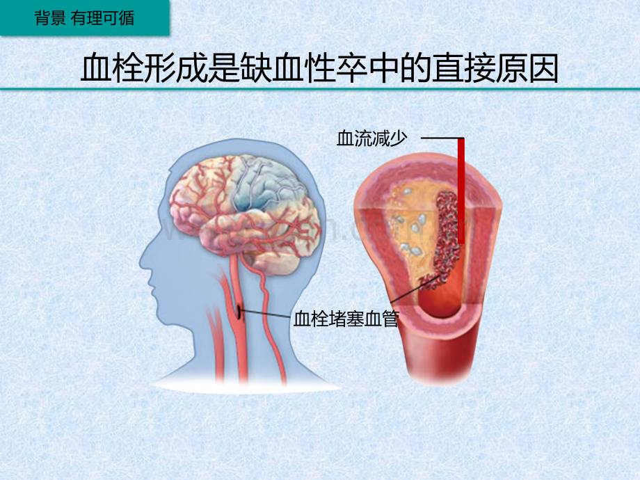 脑梗死再灌注治疗.ppt_第3页