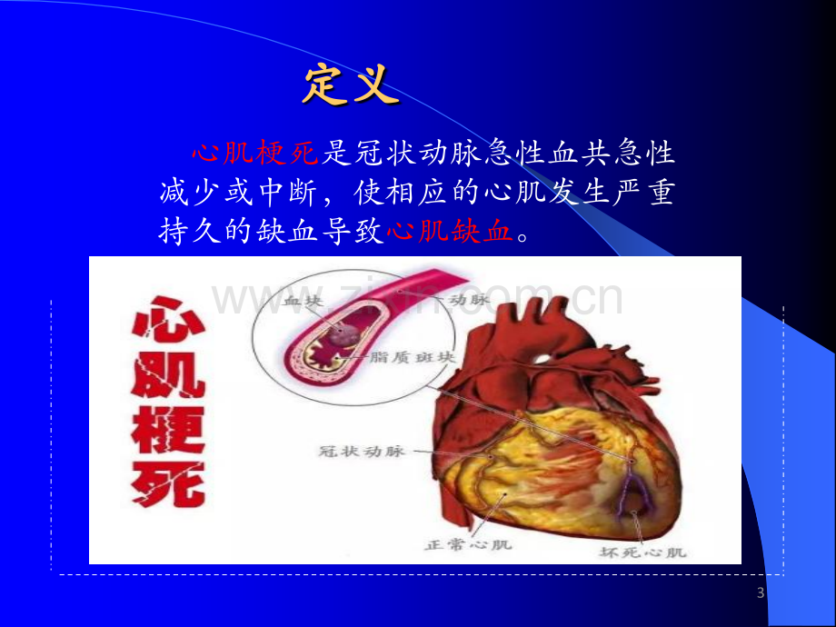 心肌梗死的护理.ppt_第3页