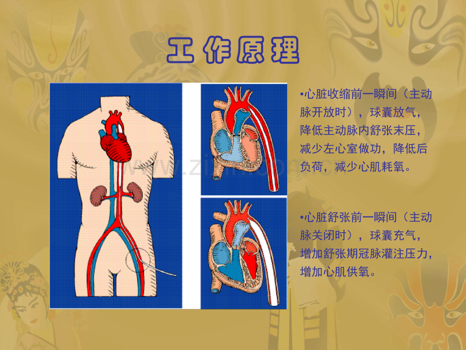 IAB主动脉内球囊反搏泵置管术ppt课件.ppt_第3页