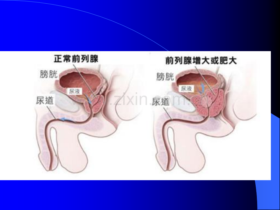 前列腺电切术后的护理ppt课件.pptx_第3页