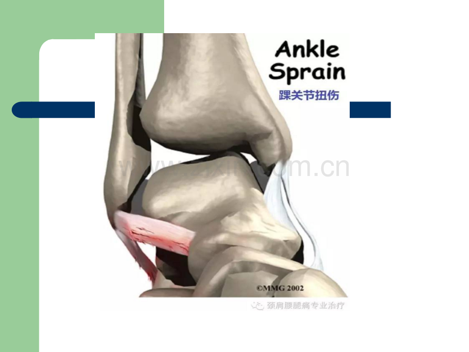 踝关节扭伤的患者指南ppt课件.pptx_第3页