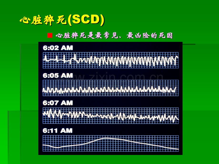 恶性室性心律失常的危险分层与治疗评价ppt课件.ppt_第3页