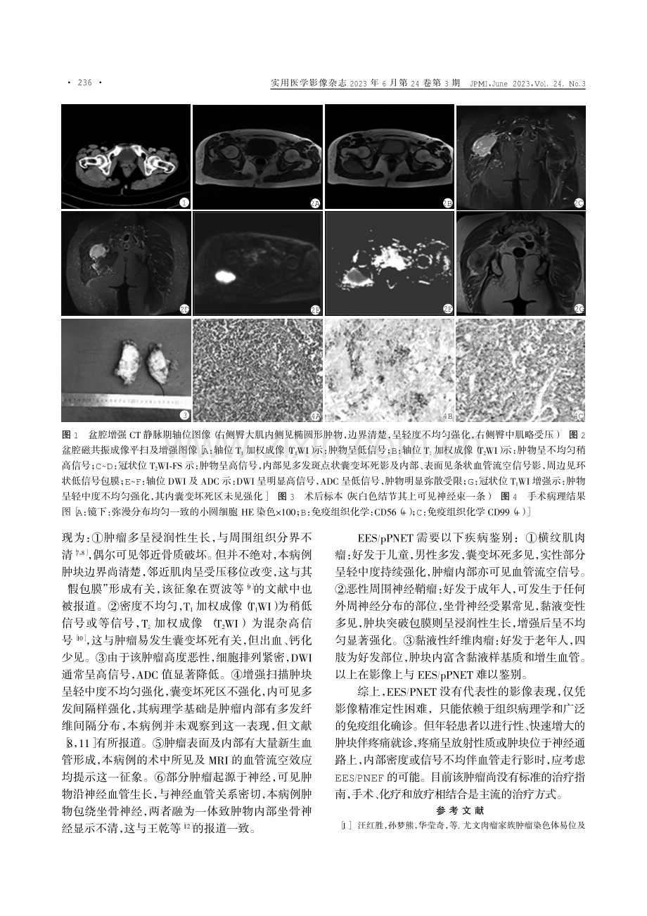 中老年坐骨神经骨外尤文肉瘤_外周原始神经外胚层肿瘤1例.pdf_第2页