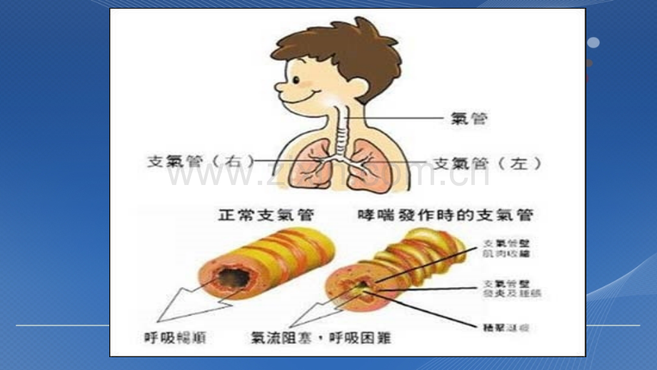 致命性哮喘.ppt_第3页