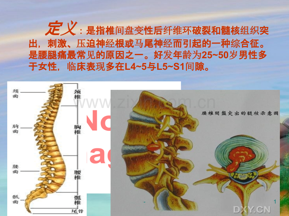 腰椎间盘突出的定义、分型、临床表现与护理PPT课件.ppt_第1页