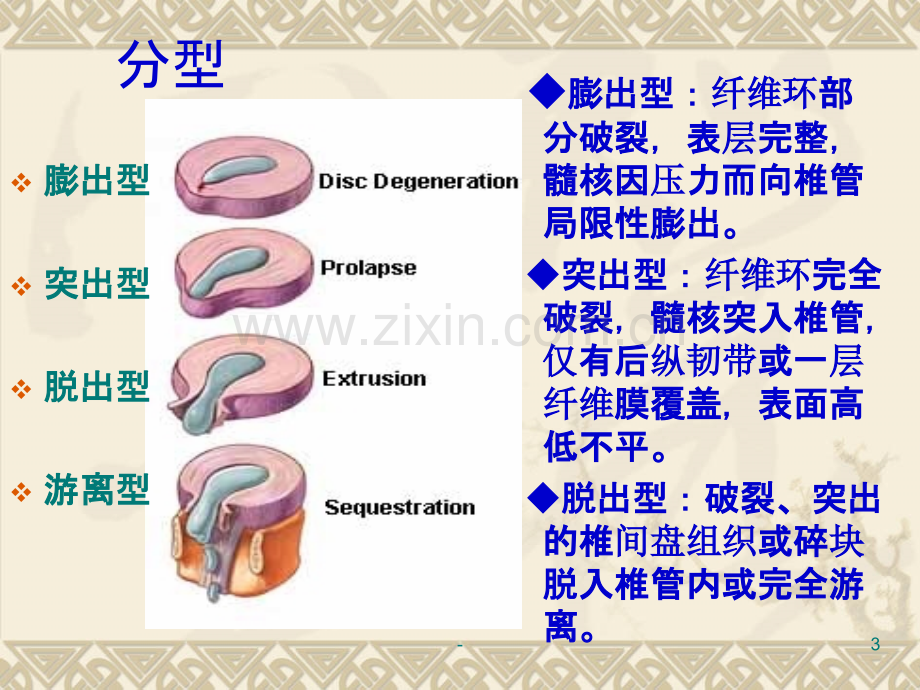 腰椎间盘突出的定义、分型、临床表现与护理PPT课件.ppt_第3页