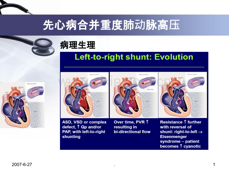 先心病并重度肺动脉高压治疗单中心经验PPT课件.ppt_第1页