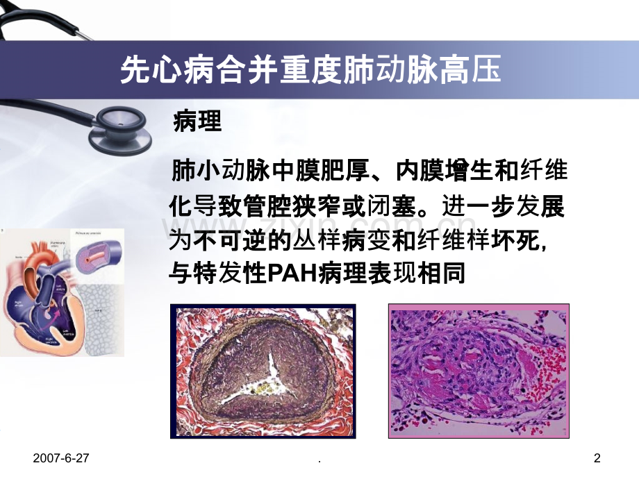 先心病并重度肺动脉高压治疗单中心经验PPT课件.ppt_第2页