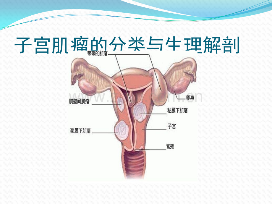 子宫肌瘤的护理查房ppt课件.pptx_第2页