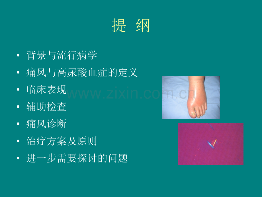 中国痛风临床诊治指南解读.ppt_第2页