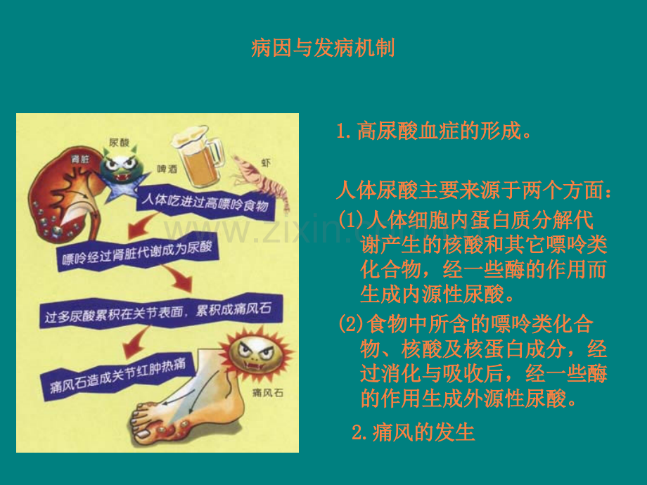 痛风性关节炎及护理.ppt_第3页