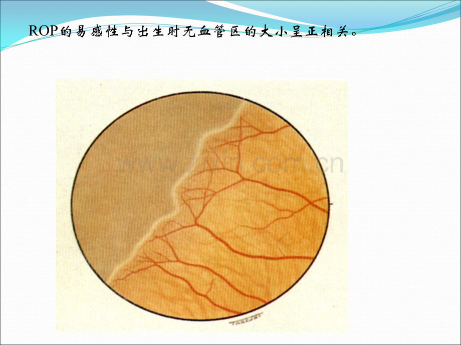 早产儿视网膜病.ppt_第3页