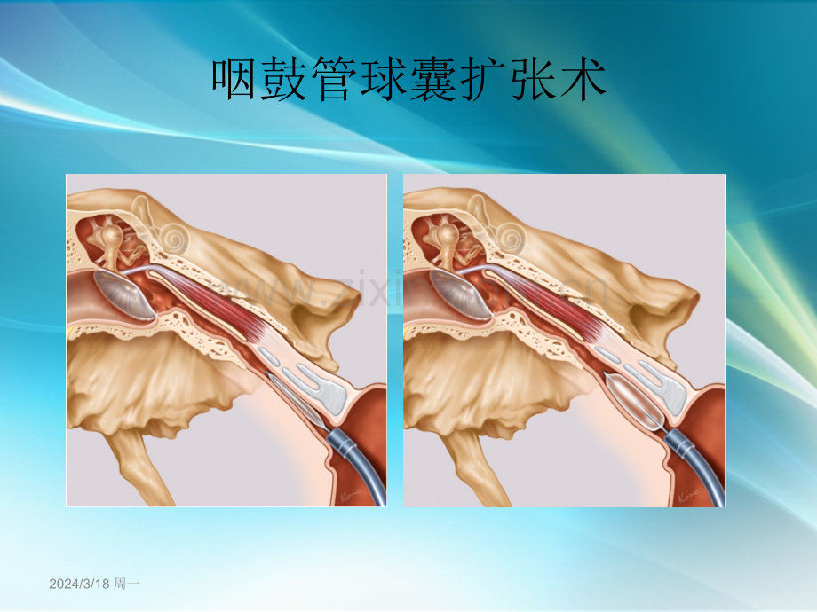 咽鼓管扩张术及全球应用.ppt_第2页