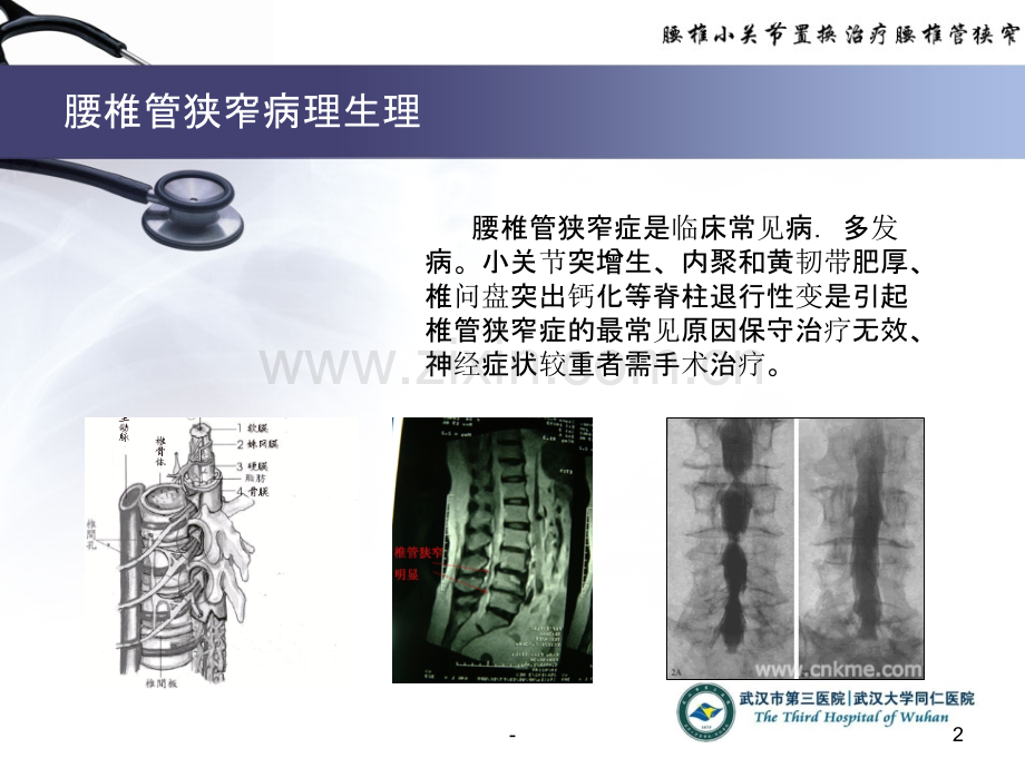 腰椎小关节置换治疗椎管狭窄(终稿)PPT课件.ppt_第2页