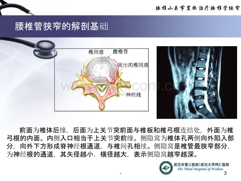 腰椎小关节置换治疗椎管狭窄(终稿)PPT课件.ppt_第3页