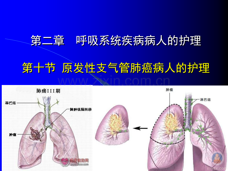 第二章第十节--原发性支气管肺癌病人的护理ppt课件.ppt_第1页