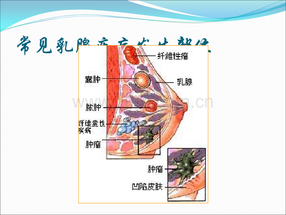 产前产后的乳房保健ppt课件.ppt_第3页