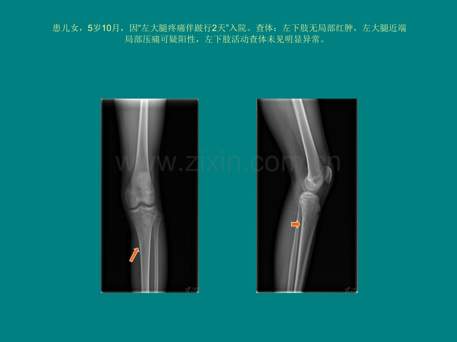 非骨化性纤维瘤病与骨纤维皮质缺损的鉴别.ppt_第2页