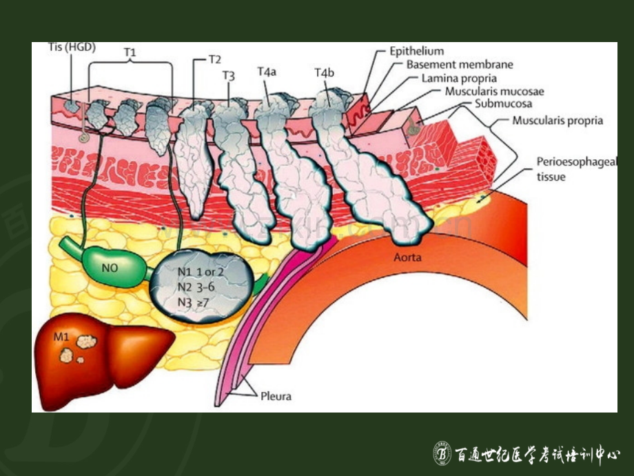 胃癌NM分期.ppt_第3页