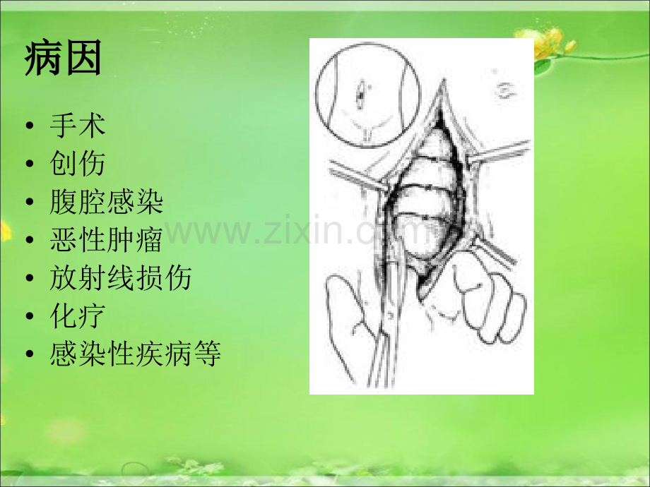 肠瘘病人的护理.ppt_第3页