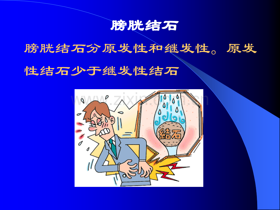 膀胱结石病人的护理ppt课件.ppt_第2页