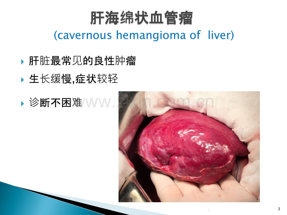其他肝脏肿瘤及肝脏疾病诊治进展ppt课件.pptx_第3页