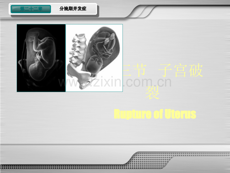 子宫破裂-Microsoft-PowerPoint-演示文稿.ppt_第2页
