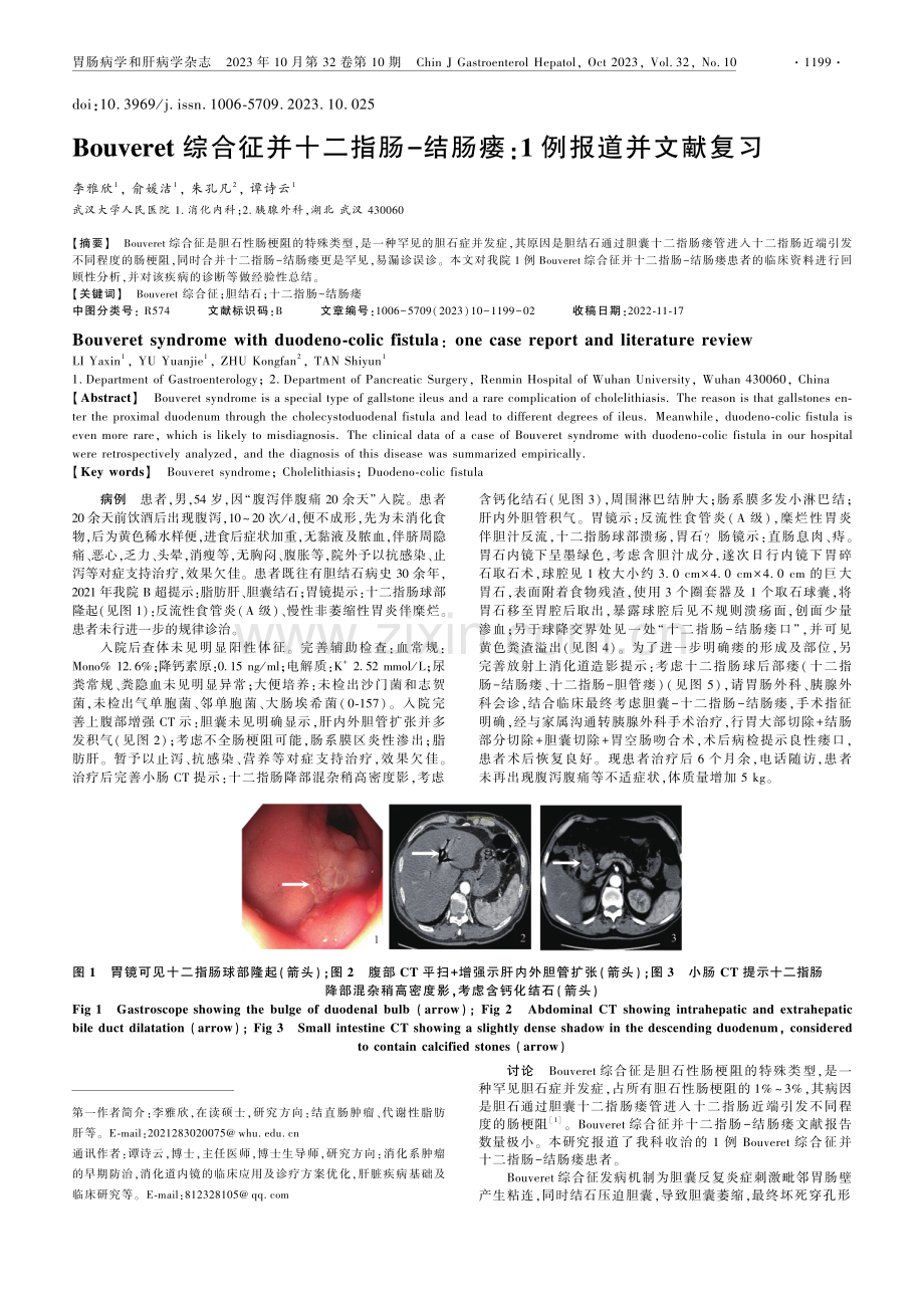 Bouveret综合征并十二指肠-结肠瘘：1例报道并文献复习.pdf_第1页