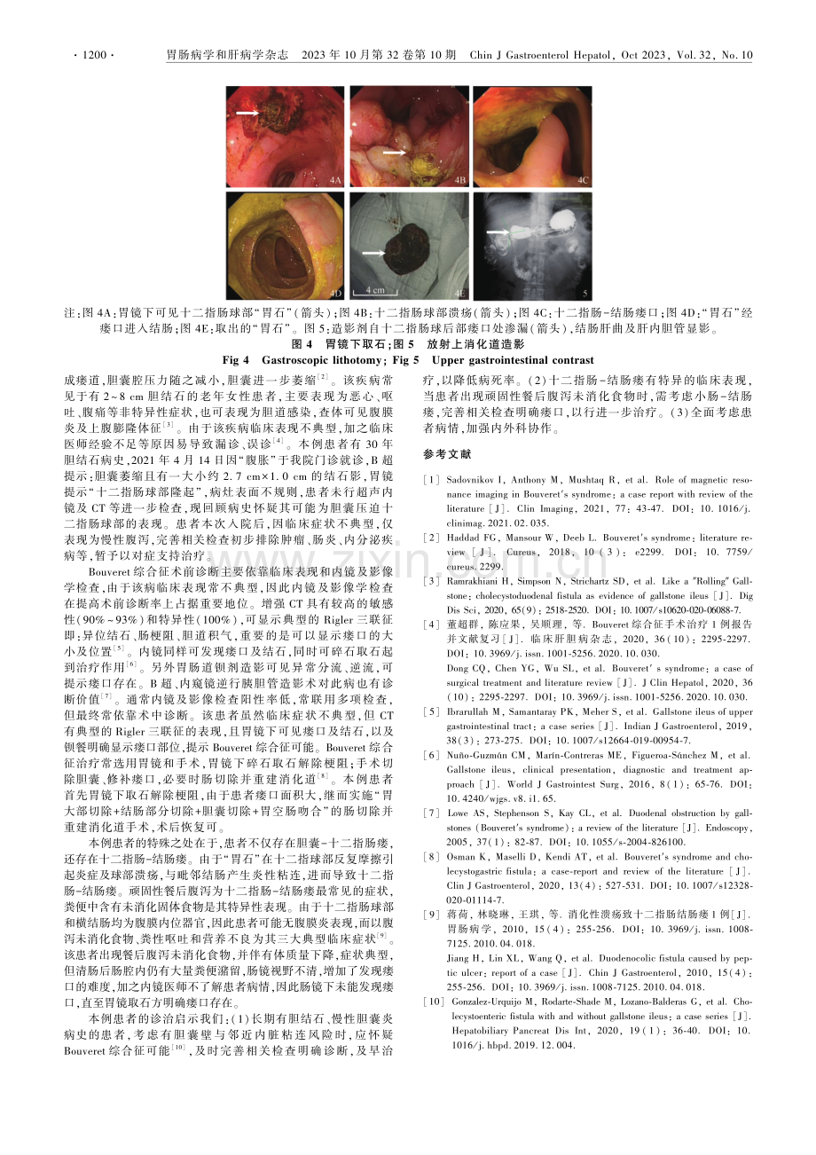 Bouveret综合征并十二指肠-结肠瘘：1例报道并文献复习.pdf_第2页