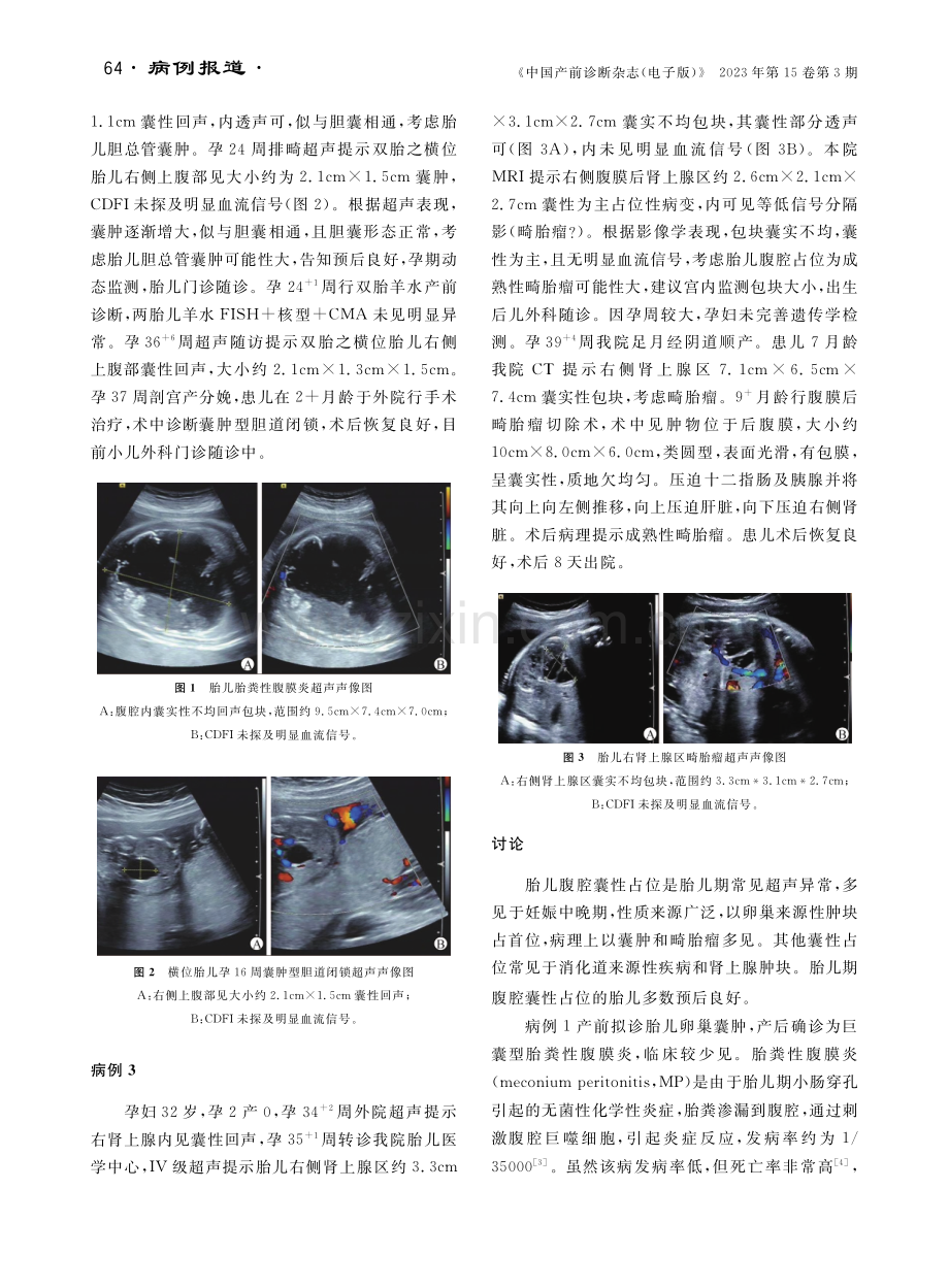 3例特殊类型胎儿腹腔占位并文献分析.pdf_第2页