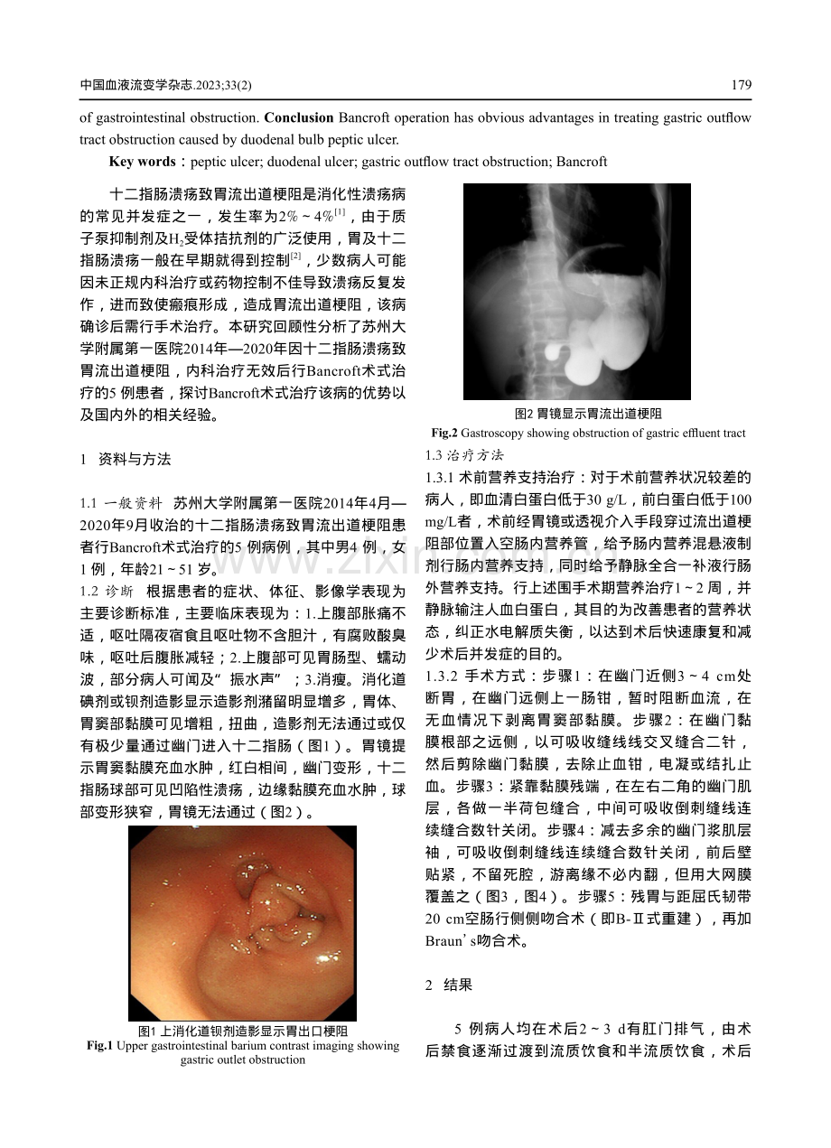 Bancroft术式治疗十二指肠球部溃疡伴胃流出道梗阻5例临床诊治分析.pdf_第2页