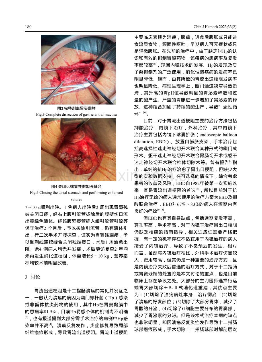 Bancroft术式治疗十二指肠球部溃疡伴胃流出道梗阻5例临床诊治分析.pdf_第3页