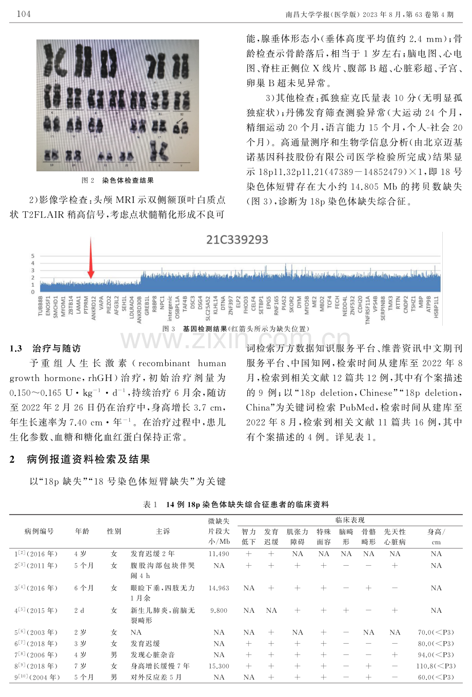 1例18p染色体缺失综合征的临床表型及遗传学分析.pdf_第2页