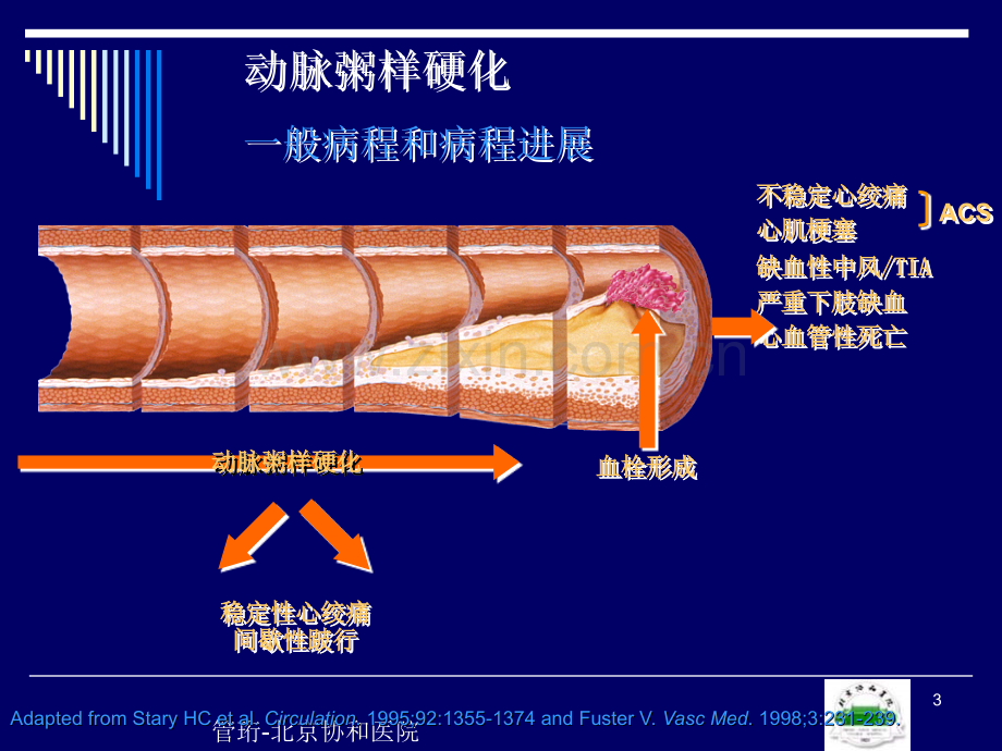 下肢动脉闭塞症PAD管珩教学.pptx_第3页