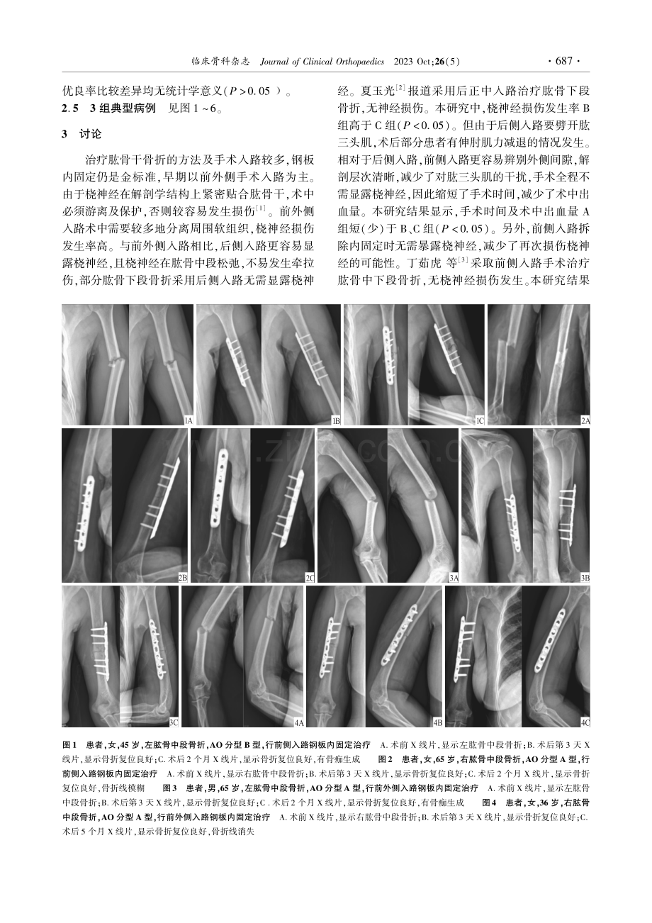 3种入路钢板内固定治疗肱骨中、下段骨折的疗效比较.pdf_第3页