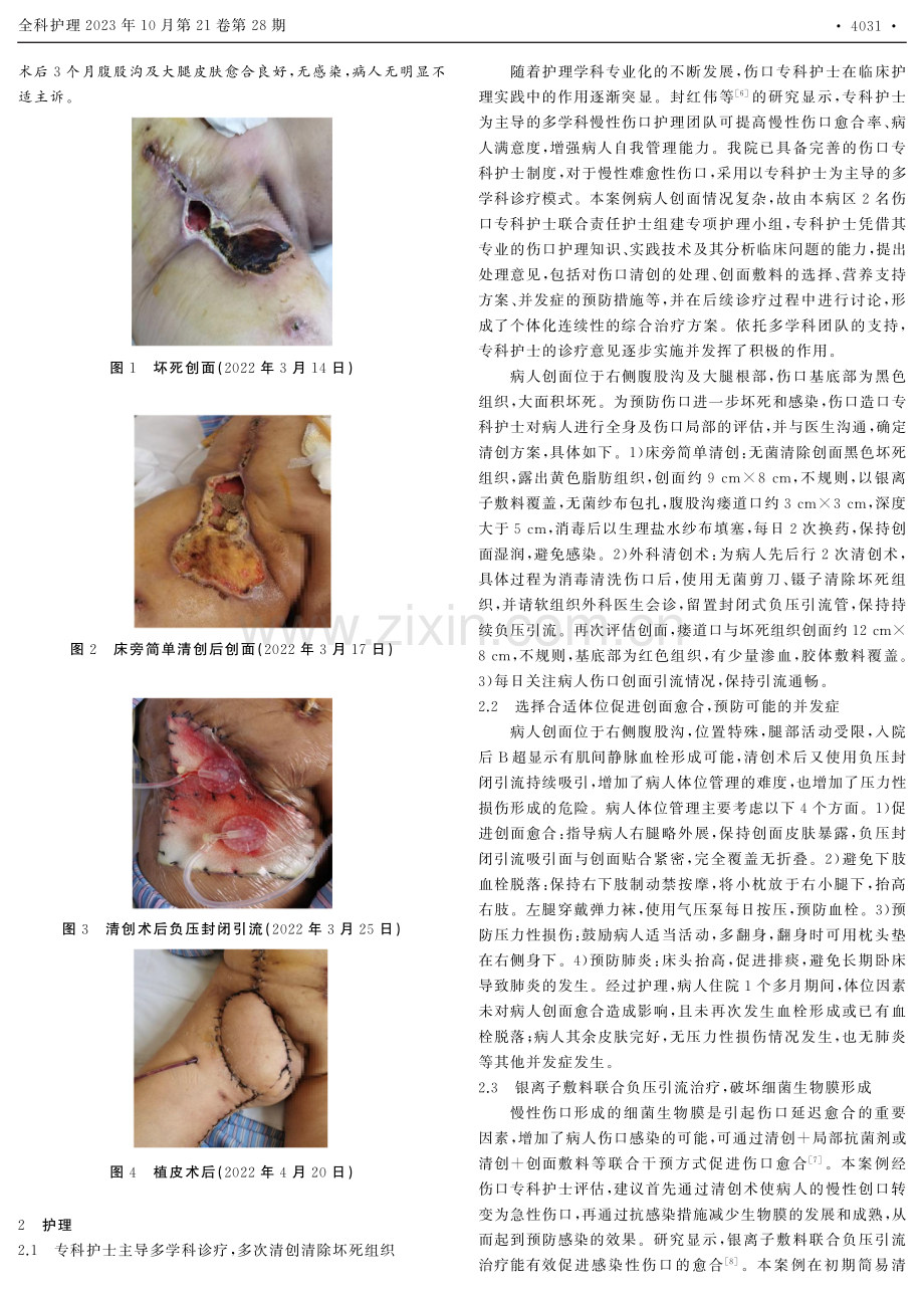 1例清创术伴负压引流联合皮瓣移植应用于外阴癌创面坏死的护理.pdf_第2页